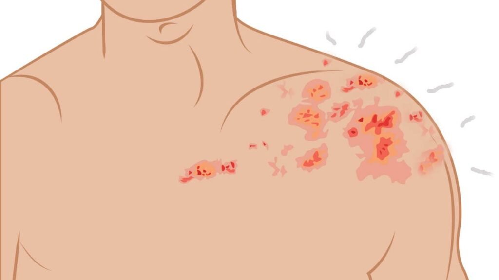 JERAWAT YANG TERNYATA HERPES ZOSTER VIRAL, INI PENJELASANNYA!